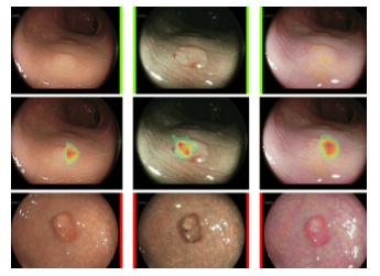 
Nhiều thuật toán AI được sủ dụng trong nội soi giúp đánh giá polyp chính xác hơn
