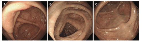 Spontaneous mesenteric atherosclerosis associated with long-term administration of geniposide