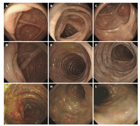 
Các hình ảnh nội soi ở bệnh nhân xơ vữa mạc treo tự phát. Hình A-C: Nội soi đại tràng trường hợp 3 cho thấy có sự đổi màu xanh nhạt ở đại tràng ngang; Hình D-F: Nội soi đại tràng trường hợp 2 cho thấy niêm mạc xung huyết phù nề với sắc tố, và sự đổi màu xanh đậm kéo dài đến đại tràng ngang; GI: Nội soi đại tràng 1 trường hợp cho thấy niêm mạc đại tràng phù nề màu tím sẫm và những thay đổi xơ cứng của thành đại tràng kéo dài từ manh tràng đến chỗ uốn lách của đại tràng.

