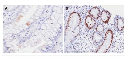 
Viêm đại tràng do Cytomegalovirus. A: Độ nhạy với kháng nguyên cytomegalovirus sớm trên hóa miễn dịch; và B: Độ nhạy với kháng nguyên Ki-67 trên phương pháp hóa miễn dịch.
