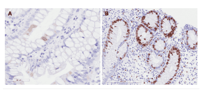 
Viêm đại tràng do Cytomegalovirus. A: Độ nhạy với kháng nguyên cytomegalovirus sớm trên hóa miễn dịch; và B: Độ nhạy với kháng nguyên Ki-67 trên phương pháp hóa miễn dịch.
