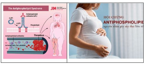 
Hội chứng kháng Phospholipid (APS) với phụ nữ mang thai
