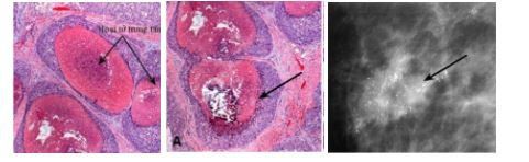 
Mô ung thư vú bị hoại tử - Hình thành các vôi hóa tại vị trí hoại tử - Các vôi hóa ác tính được phát hiện trên Xquang
