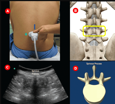 Patients experiencing back pain after spinal anesthesia need a thorough examination to determine the cause.