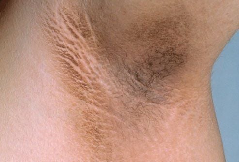 
Acanthosis nigricans tại da vùng nách của người bệnh
