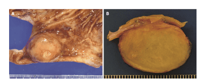 Differential diagnosis of calcified fibrous tumors