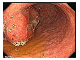 
Schwannomas dạ dày. (a) Hình ảnh CT tăng cường độ tương phản theo trục ở một phụ nữ 69 tuổi cho thấy một schwannoma (mũi tên), được phát hiện tình cờ trong quá trình làm GIST. (b) Hình ảnh nội soi trên cùng một bệnh nhân cho thấy khối có niêm mạc nhẵn. (c, d) Hình ảnh CT tăng cường cản quang theo trục thu được ở hai cấp độ cho thấy một schwannoma (*) dài 17 cm ở một phụ nữ 35 tuổi có tiền sử khó chịu ở bụng trong vài năm. Lưu ý tính đồng nhất tương đối của khối u, điều này sẽ không bình thường đối với GIST ở kích thước này.
