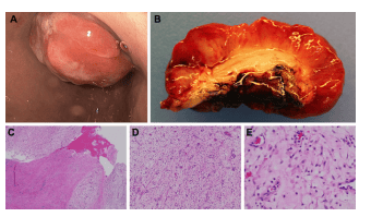 
Các đặc điểm nội soi và giải phẫu bệnh của khối u Plexiform fibromyxoma dạ dày. Trên nội soi dạ dày, mô bở dễ vỡ vụn chia thùy khối được nhìn thấy ở hang môn vị và cản trở dây soi qua môn vị (A). Khối u cho thấy bề mặt loét rộng (B). Các phần nhuộm màu hematoxylin và eosin của khối chứng tỏ các đặc điểm cổ điển của u sợi quang plexiform. Tổn thương được sắp xếp theo mô hình phát triển đám rối kéo dài vào thành dạ dày (độ phóng đại C, 4 ×). Chất đệm lỏng lẻo phân tách nhiều mạch nhỏ (D, độ phóng đại 10 lần) và các tế bào hình thoi (E, độ phóng đại 20 lần).
