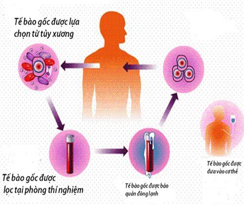 
Nguồn tế bào gốc từ tủy xương được sử dụng trong ghép tế bào gốc điều trị bệnh bạch cầu cấp
