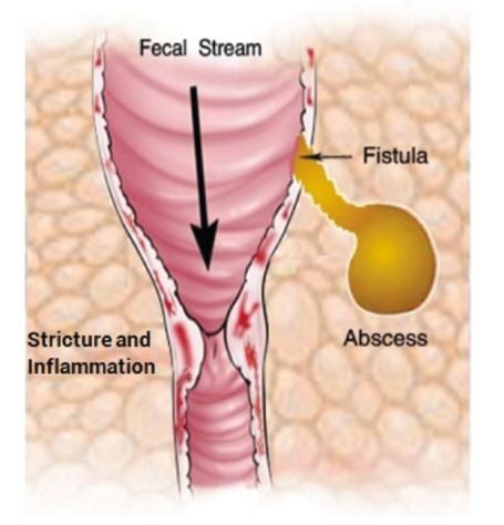 Hẹp ống tiêu hóa gây tắc ruột, táo bón là một trong các biến chứng của bệnh Crohn