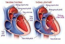 Cần phải làm gì thai nhi bị thông liên thất?