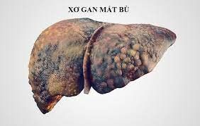 Is cirrhosis of the liver F4 curable?