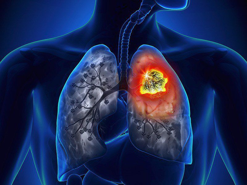 Overview of the causes of lung cancer | Vinmec