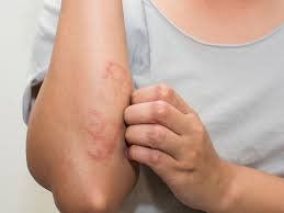 How to treat contact dermatitis?