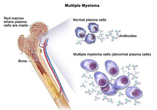 
Xét nghiệm beta2 - microglobulin được sử dụng để chẩn đoán ung thư
