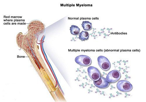 Xét nghiệm beta2 - microglobulin được sử dụng để chẩn đoán ung thư