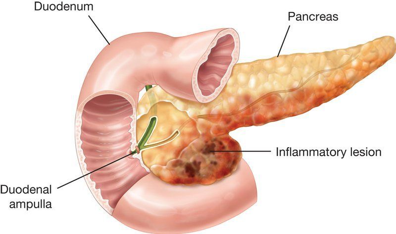 Common pancreatic disorders