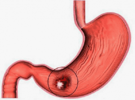 Viêm loét dạ dày mãn tính có thể gây ung thư?