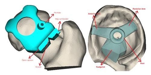 
Hình minh họa: dụng cụ định vị phẫu thuật khớp háng in 3D
