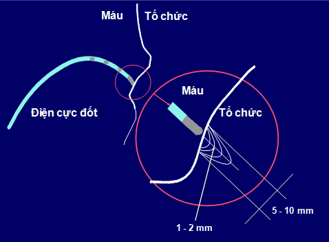 
Điều trị rối loạn nhịp tim ở trẻ em bằng cách đốt triệt với sóng radio cao tần
