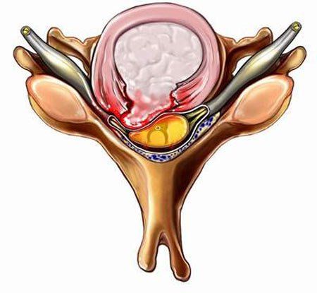 
Lồi đĩa đệm cột sống cổ là tình trạng phần nhầy của đĩa đệm lồi ra
