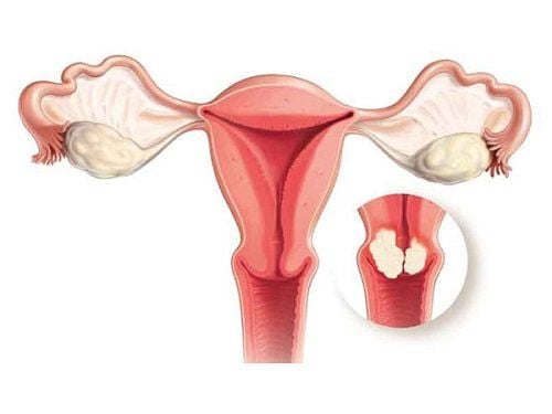 
Dính buồng tử cung sau hút thai làm giảm kích thước tử cung
