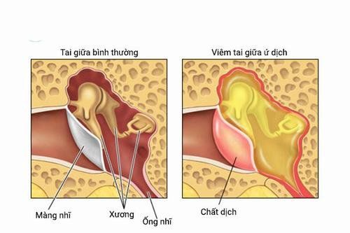 Có thể điều trị viêm tai giữa ứ dịch gây nghe kém được không?