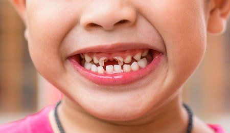 What if the baby's teeth are corroded?