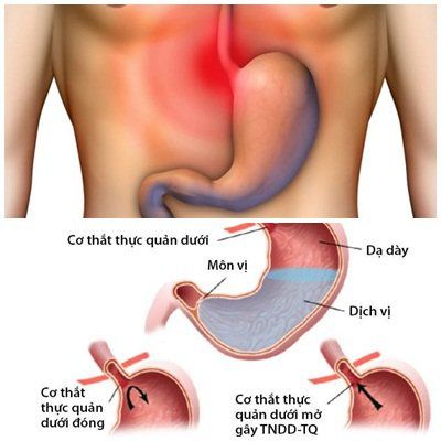 How do people who drink a lot of alcohol treat gastroesophageal reflux?