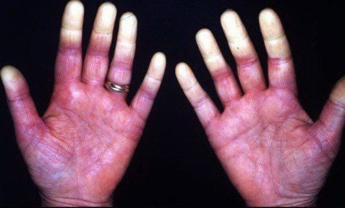 
Bệnh đau đa khớp thường xuất hiện kèm bệnh Raynaud
