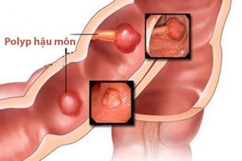 Are anal polyps dangerous?