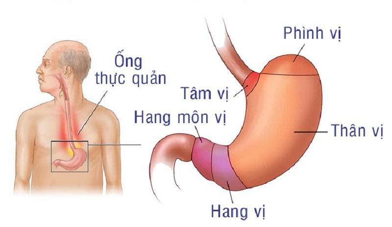 Giãn Tĩnh Mạch Phình Vị: Nguyên Nhân, Triệu Chứng và Cách Điều Trị Hiệu Quả