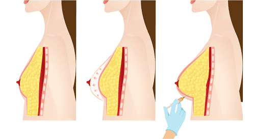 Đau nhức ngực sau nâng ngực bằng mỡ tự thân phải làm sao?