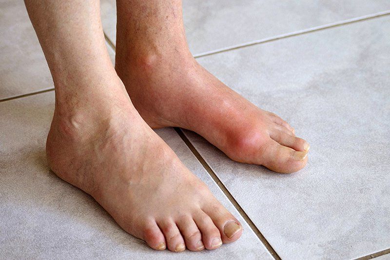 Chân Bị Gout: Triệu Chứng, Nguyên Nhân và Cách Điều Trị Hiệu Quả