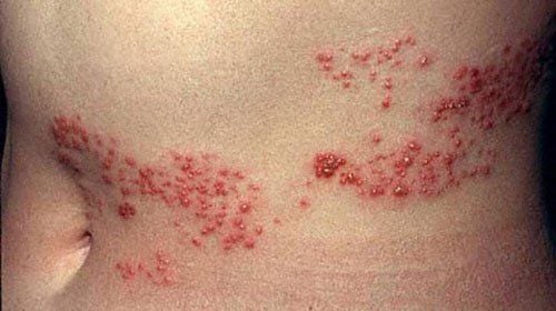 
HIV infection through sexual intercourse causes the patient to develop herpes zoster