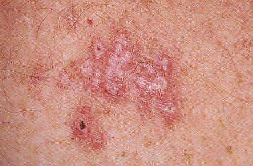 Quan hệ không dùng bao cao su tránh thai bạn có thể nhiễm bệnh lậu