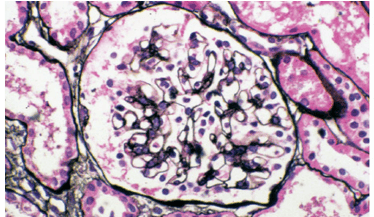 Hematuria: Causes, problems with access and laboratory tests