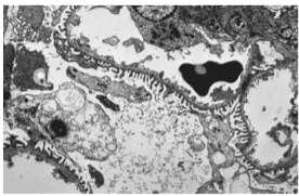 Hematuria: Causes, problems with access and laboratory tests