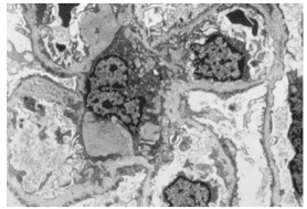 Hematuria: Causes, problems with access and laboratory tests