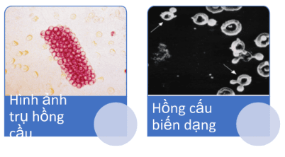 Tiểu máu: Nguyên nhân, các vấn đề khi tiếp cận và xét nghiệm cận lâm sàng