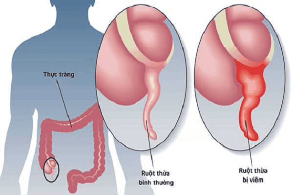 Ruột Thừa Bình Thường: Khám Phá Tầm Quan Trọng và Vai Trò Trong Sức Khỏe