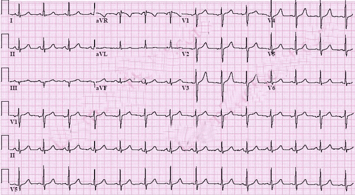 Is irregular sinus rhythm in men dangerous? | Vinmec