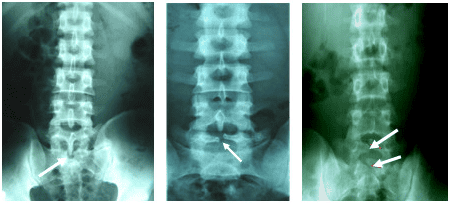 Kết quả chụp Xquang có gai các thân đốt sống nghĩa là gì?