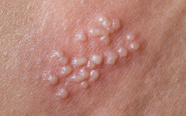 4. Phương pháp chẩn đoán herpes sinh dục