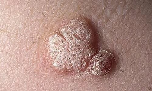 
Mụn cóc sinh dục ở vùng kín thường do virus u nhú ở người (HPV) gây ra
