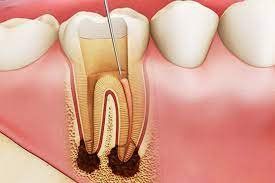 Nữ giới đau nhức răng đã lấy tủy nên làm gì?