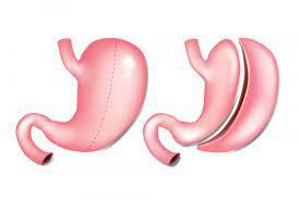 What is the cause of abdominal fluid after gastric bypass surgery?