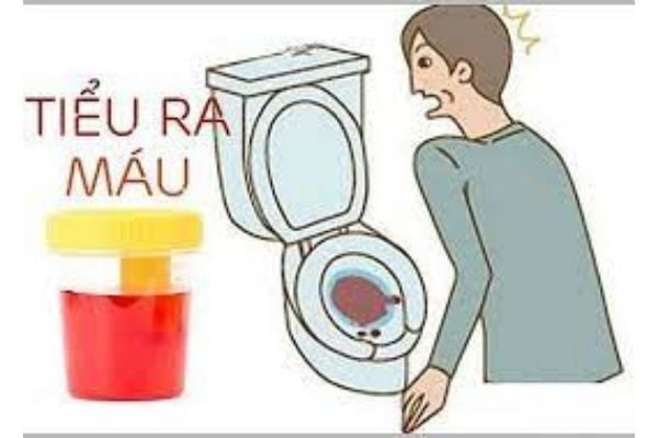 3. Triệu Chứng Đi Kèm Với Tiểu Ra Máu