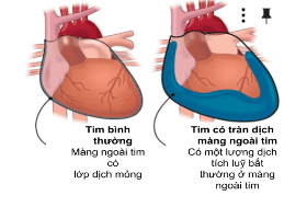 Ultrasound diagnosis of pericardial effusion