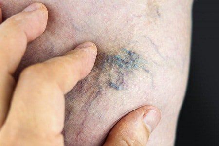 How dangerous is a varicose vein?